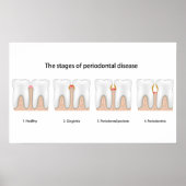 Tandaandoening Periodontale Poster (Voorkant)