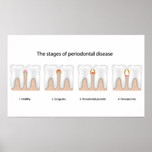 Tandaandoening Periodontale Poster