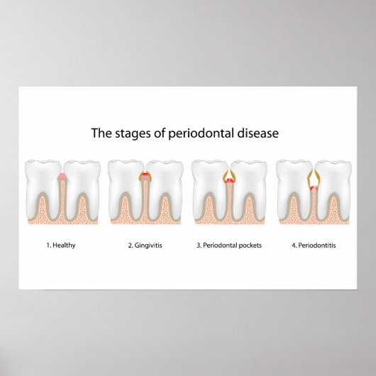 Tandaandoening Periodontale Poster (Voorkant)