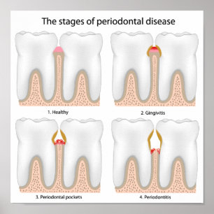Tandaandoening Periodontale Poster