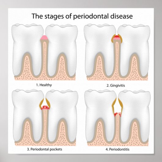 Tandaandoening Periodontale Poster (Voorkant)