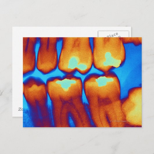 Tanden met vullingen (groen), gekleurde röntgenfot briefkaart (Voorkant / Achterkant)