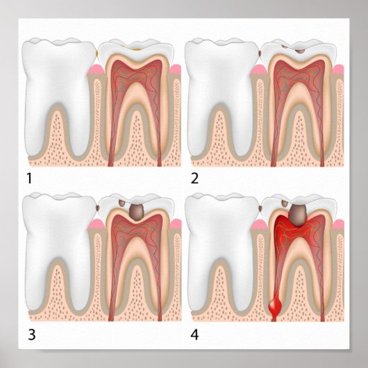 Tandverval Poster (Voorkant)