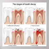 Tandverval Poster (Voorkant)