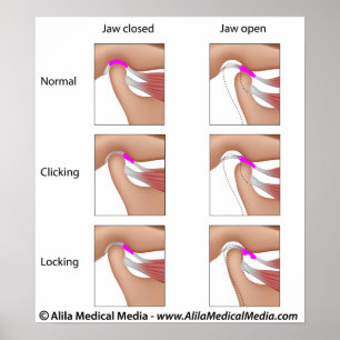 Temporomandibulaire gewrichtsdisfunctie, TMJ of TM Poster