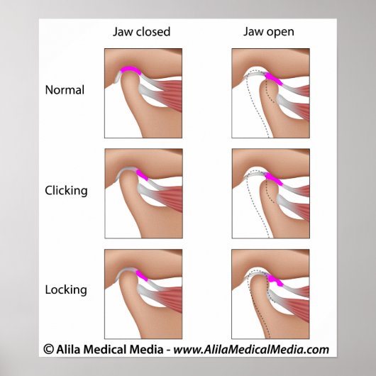 Temporomandibulaire gewrichtsdisfunctie, TMJ of TM Poster (Voorkant)