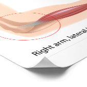 Tennis elbow Poster sportletsel (Hoek)