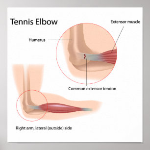 Tennis elbow Poster sportletsel