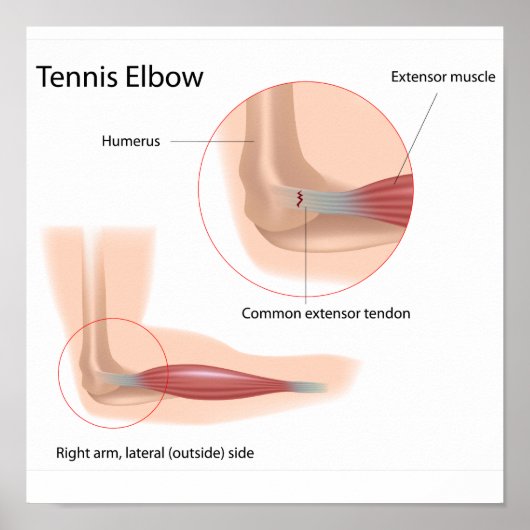 Tennis elbow Poster sportletsel (Voorkant)