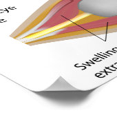 Thyroïd eye disease Poster (Hoek)