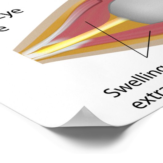 Thyroïd eye disease Poster (Hoek)