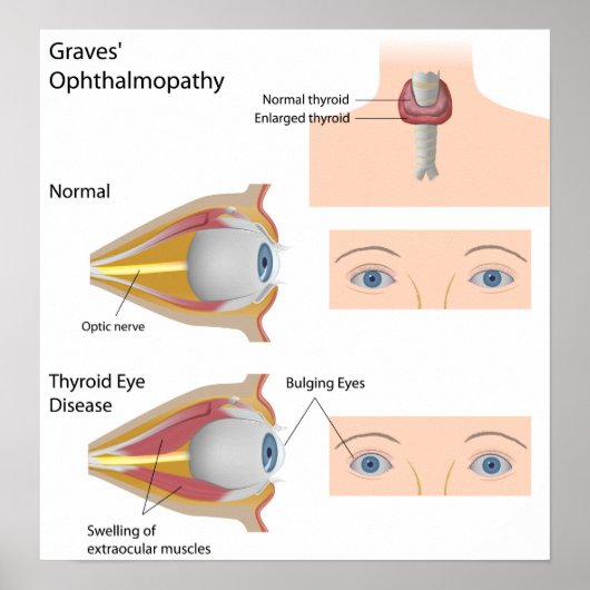 Thyroïd eye disease Poster (Voorkant)