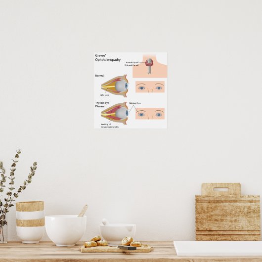 Thyroïd eye disease Poster (Keuken)
