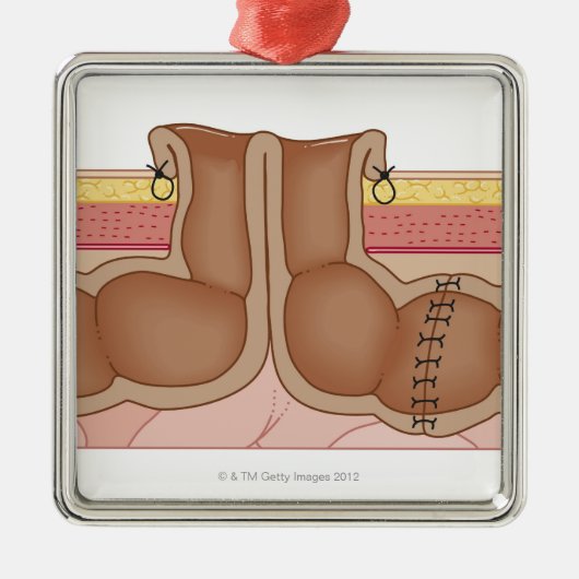 Tijdelijke kolostomie metalen ornament (Voorkant)