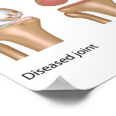 Totaal poster voor knievervanging (Hoek)