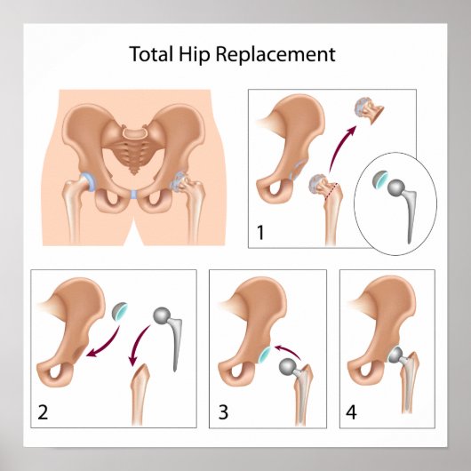Totale druk voor heupvervangende operaties poster (Voorkant)