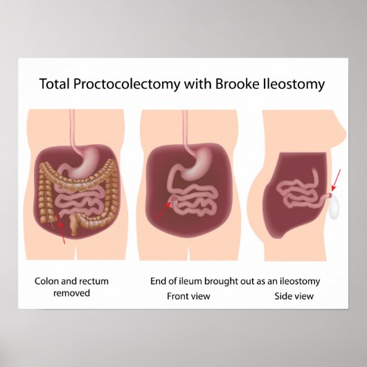 Totale proctocolectomie met poster van Brooke ileo (Voorkant)
