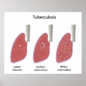 Tuberculose type Poster (Voorkant)