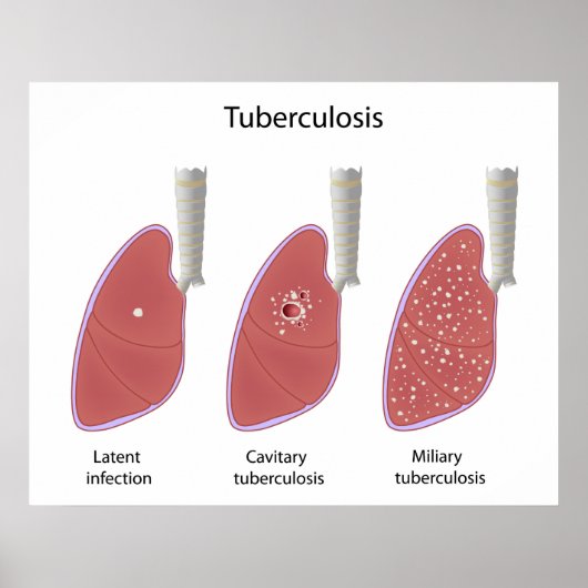 Tuberculose type Poster (Voorkant)