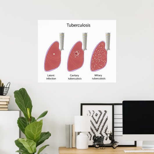 Tuberculose type Poster (Thuiskantoor)