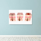 Uitzicht van wat acne veroorzaakt canvas afdruk (Insitu (Houten vloer))