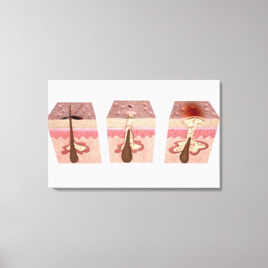Uitzicht van wat acne veroorzaakt canvas afdruk (Voorkant)