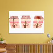 Uitzicht van wat acne veroorzaakt canvas afdruk (Insitu (Woonkamer))