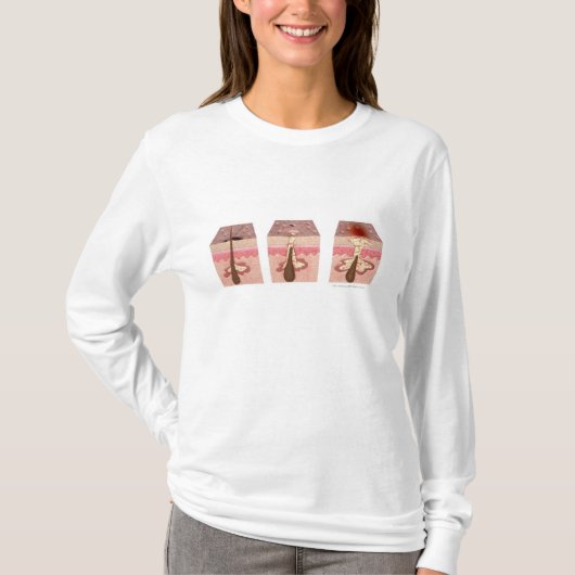 Uitzicht van wat acne veroorzaakt t-shirt (Voorkant)