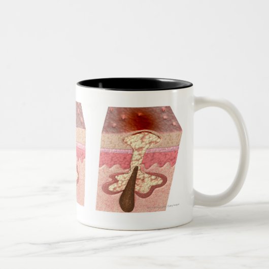 Uitzicht van wat acne veroorzaakt tweekleurige koffiemok (Rechts)