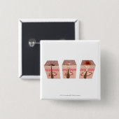 Uitzicht van wat acne veroorzaakt vierkante button 5,1 cm (Voorkant /achterkant)