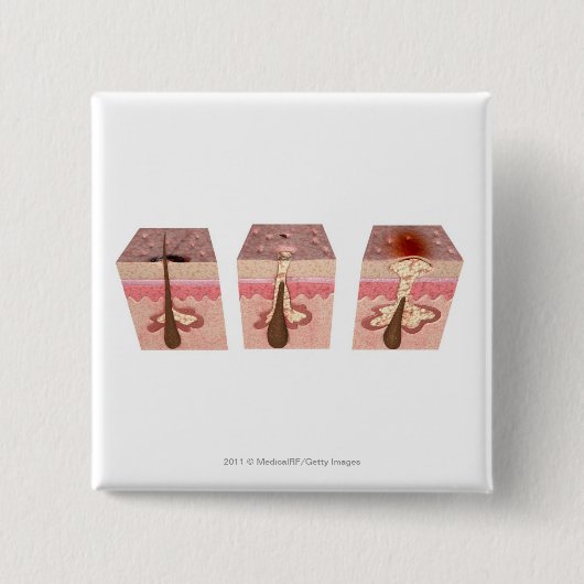 Uitzicht van wat acne veroorzaakt vierkante button 5,1 cm (Voorkant)