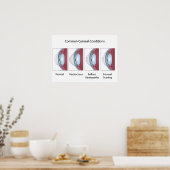 Vaak voorkomende cornea-aandoeningen Poster (Keuken)