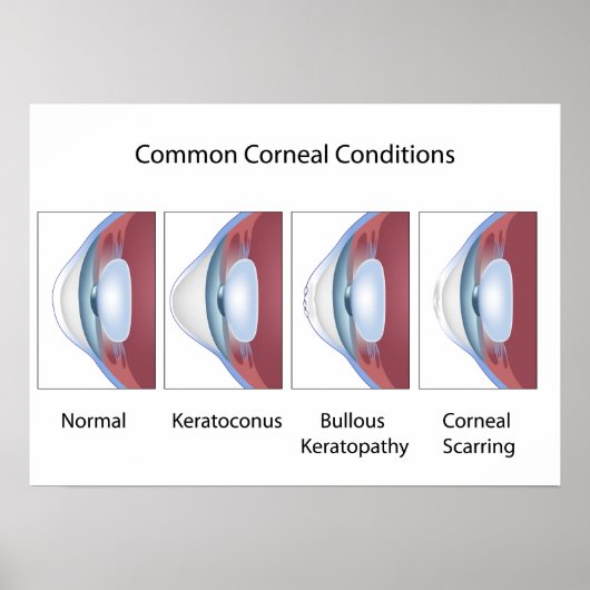 Vaak voorkomende cornea-aandoeningen Poster (Voorkant)