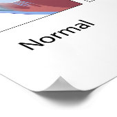 Vaak voorkomende cornea-aandoeningen Poster (Hoek)