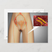 Verkleinde arterie nabij been briefkaart (Voorkant / Achterkant)