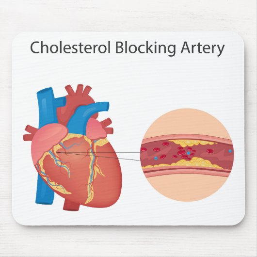 Vernauwde bloedvaten muismat (Voorkant)