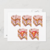 Verschillende soorten Acne Briefkaart (Voorkant / Achterkant)