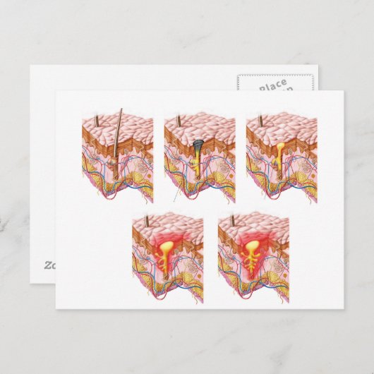 Verschillende soorten Acne Briefkaart (Voorkant / Achterkant)