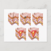 Verschillende soorten Acne Briefkaart (Voorkant)