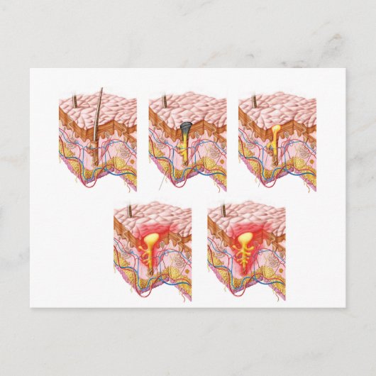 Verschillende soorten Acne Briefkaart (Voorkant)