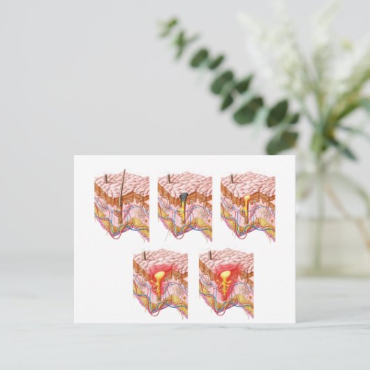 Verschillende soorten Acne Briefkaart (Staand voorkant)