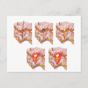 Verschillende soorten Acne Briefkaart