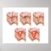 Verschillende soorten Acne Poster (Voorkant)