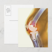 Vervanging knie. Röntgenfoto's, gekleurd, van een  Briefkaart (Voorkant / Achterkant)