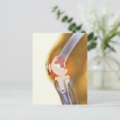 Vervanging knie. Röntgenfoto's, gekleurd, van een  Briefkaart (Staand voorkant)