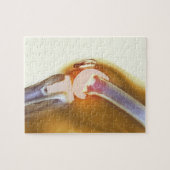 Vervanging knie. Röntgenfoto's, gekleurd, van een  Legpuzzel (Horizontaal)