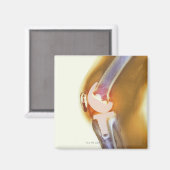 Vervanging knie. Röntgenfoto's, gekleurd, van een  Magneet (Voorkant / Achterkant)