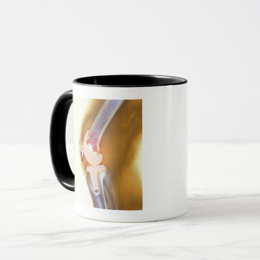 Vervanging knie. Röntgenfoto's, gekleurd, van een Mok (Voorkant links)