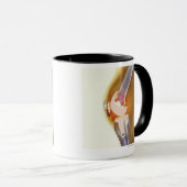 Vervanging knie. Röntgenfoto's, gekleurd, van een Mok (Voorkant rechts)