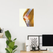Vervanging knie. Röntgenfoto's, gekleurd, van een  Poster (Thuiskantoor)